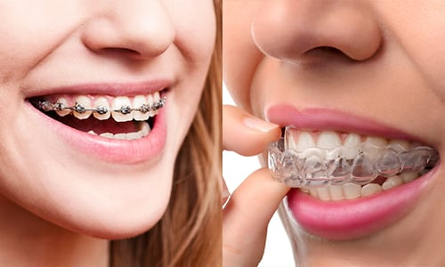 Clear-Aligners-vs.-Traditional-Braces-JC-Dental.jpg
